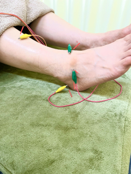 メニュー：局所鍼 イメージ